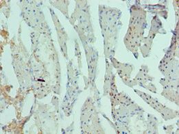 RAD51L3 / RAD51D Antibody - Immunohistochemistry of paraffin-embedded human prostate cancer using antibody at 1:100 dilution.