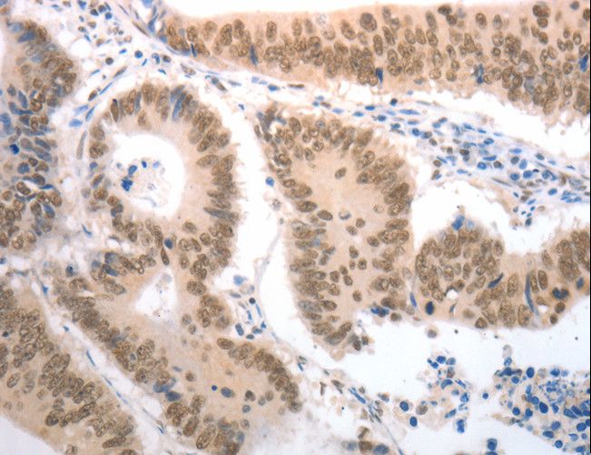 RAD52 Antibody - Immunohistochemistry of paraffin-embedded Human ovarian cancer using RAD52 Polyclonal Antibody at dilution of 1:50.