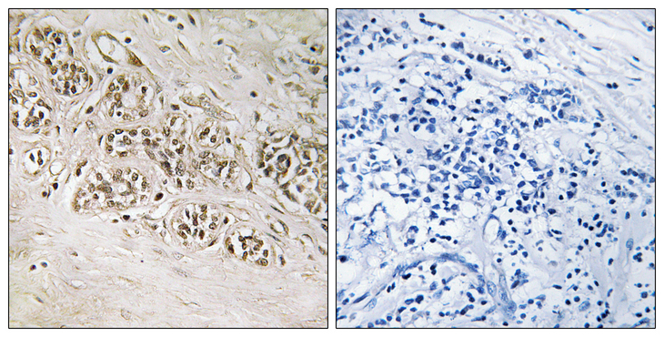 RAD54B Antibody - Immunohistochemistry analysis of paraffin-embedded human breast carcinoma, using RAD54B Antibody. The picture on the right is blocked with the synthesized peptide.