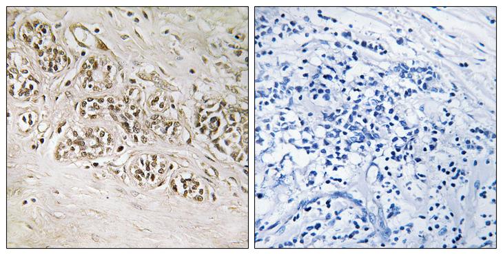 RAD54B Antibody - Peptide - + Immunohistochemistry analysis of paraffin-embedded human breast carcinoma tissue using RAD54B antibody.