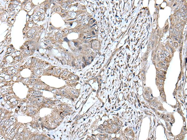 RAD54B Antibody - Immunohistochemistry of paraffin-embedded Human colorectal cancer tissue  using RAD54B Polyclonal Antibody at dilution of 1:45(×200)