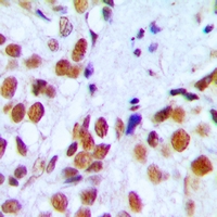 RAD54L Antibody - Immunohistochemical analysis of RAD54A staining in human breast cancer formalin fixed paraffin embedded tissue section. The section was pre-treated using heat mediated antigen retrieval with sodium citrate buffer (pH 6.0). The section was then incubated with the antibody at room temperature and detected using an HRP polymer system. DAB was used as the chromogen. The section was then counterstained with hematoxylin and mounted with DPX.