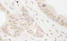RAD54L2 Antibody - Detection of Human ARIP4 by Immunohistochemistry. Sample: FFPE section of human colon carcinoma. Antibody: Affinity purified rabbit anti-ARIP4 used at a dilution of 1:250.