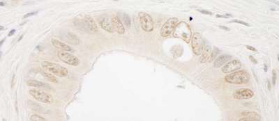 RAD54L2 Antibody - Detection of Human ARIP4 by Immunohistochemistry. Sample: FFPE section of human colon carcinoma. Antibody: Affinity purified rabbit anti-ARIP4 used at a dilution of 1:1200 (1 ug/ml).