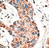 RAD9A / RAD9 Antibody - Formalin-fixed and paraffin-embedded human cancer tissue reacted with the primary antibody, which was peroxidase-conjugated to the secondary antibody, followed by AEC staining. This data demonstrates the use of this antibody for immunohistochemistry; clinical relevance has not been evaluated. BC = breast carcinoma; HC = hepatocarcinoma.