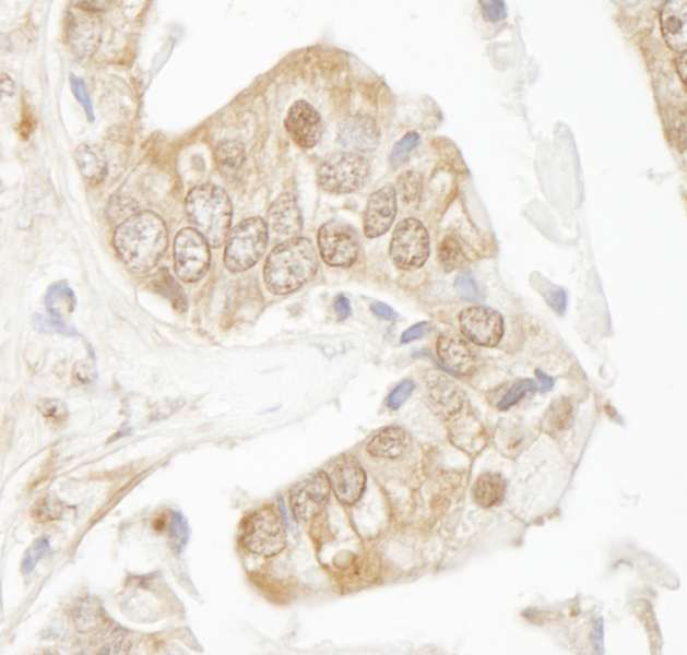 RAD9A / RAD9 Antibody - Detection of Human Rad9 by Immunohistochemistry. Sample: FFPE section of human prostate carcinoma. Antibody: Affinity purified rabbit anti-Rad9 used at a dilution of 1:250.