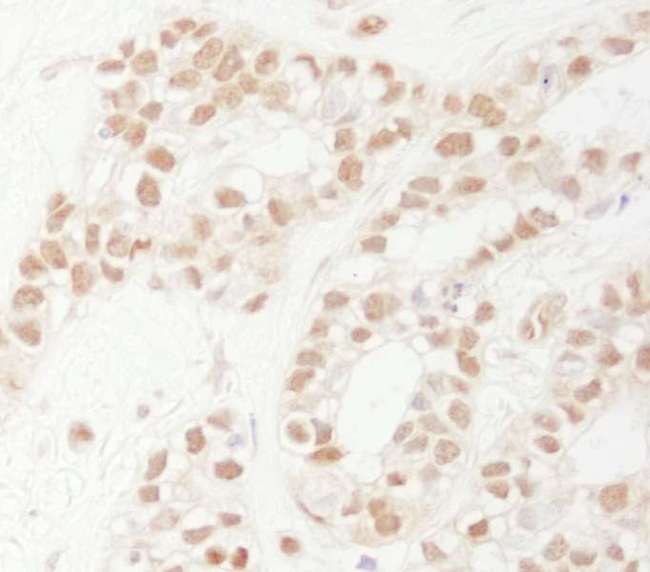 RAD9A / RAD9 Antibody - Detection of Human Rad9 by Immunohistochemistry. Sample: FFPE section of human breast carcinoma. Antibody: Affinity purified rabbit anti-Rad9 used at a dilution of 1:1000 (1 ug/ml). Detection: DAB.