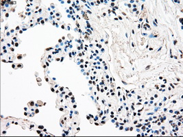 RAD9A / RAD9 Antibody - Immunohistochemical staining of paraffin-embedded Carcinoma of lung tissue using anti-RAD9A mouse monoclonal antibody. (Dilution 1:50).