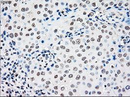 RAD9A / RAD9 Antibody - Immunohistochemical staining of paraffin-embedded Adenocarcinoma of breast tissue using anti-RAD9A mouse monoclonal antibody. (Dilution 1:50).