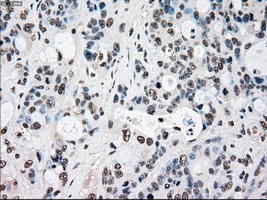RAD9A / RAD9 Antibody - Immunohistochemical staining of paraffin-embedded Adenocarcinoma of colon tissue using anti-RAD9A mouse monoclonal antibody. (Dilution 1:50).