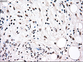 RAD9A / RAD9 Antibody - Immunohistochemical staining of paraffin-embedded Carcinoma of pancreas tissue using anti-RAD9A mouse monoclonal antibody. (Dilution 1:50).