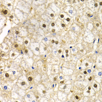 RAD9A / RAD9 Antibody - Immunohistochemistry of paraffin-embedded human liver damage.