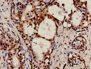 RAD9A / RAD9 Antibody - Immunocytochemistry analysis of human breast cancer at a dilution of 1:100