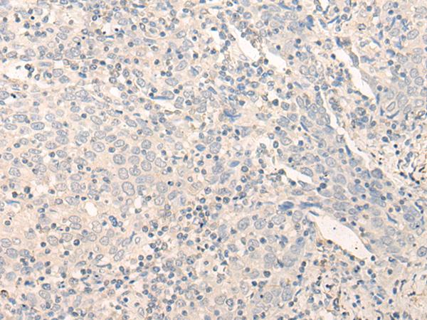 RADIL Antibody - Immunohistochemistry of paraffin-embedded Human cervical cancer tissue  using RADIL Polyclonal Antibody at dilution of 1:40(×200)
