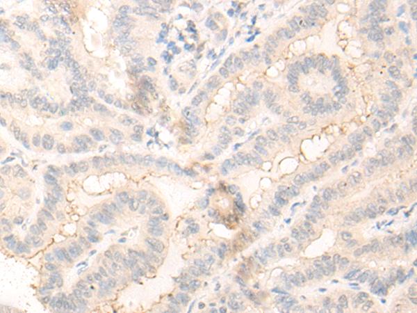 RADIL Antibody - Immunohistochemistry of paraffin-embedded Human thyroid cancer tissue  using RADIL Polyclonal Antibody at dilution of 1:30(×200)