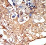 RAF1 / RAF Antibody - Formalin-fixed and paraffin-embedded human cancer tissue reacted with the primary antibody, which was peroxidase-conjugated to the secondary antibody, followed by DAB staining. This data demonstrates the use of this antibody for immunohistochemistry; clinical relevance has not been evaluated. BC = breast carcinoma; HC = hepatocarcinoma.