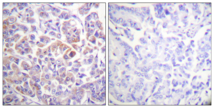 RAF1 / RAF Antibody - Immunohistochemistry analysis of paraffin-embedded human breast carcinoma tissue, using C-RAF Antibody. The picture on the right is blocked with the synthesized peptide.