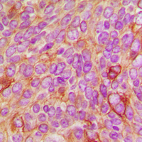 RAF1 / RAF Antibody - Immunohistochemical analysis of c-Raf/B-RAF (pT491/599) staining in human breast cancer formalin fixed paraffin embedded tissue section. The section was pre-treated using heat mediated antigen retrieval with sodium citrate buffer (pH 6.0). The section was then incubated with the antibody at room temperature and detected using an HRP conjugated compact polymer system. DAB was used as the chromogen. The section was then counterstained with hematoxylin and mounted with DPX.