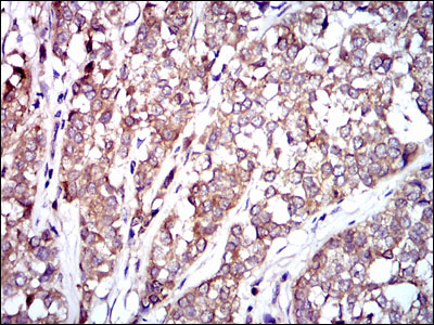 RAF1 / RAF Antibody - IHC of paraffin-embedded bladder cancer tissues using RAF1 mouse monoclonal antibody with DAB staining.