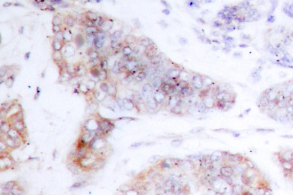 RAF1 / RAF Antibody - IHC of Raf1 (Q253) pAb in paraffin-embedded human breast carcinoma tissue.