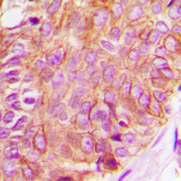 RAF1 / RAF Antibody - Immunohistochemical analysis of c-RAF staining in human breast cancer formalin fixed paraffin embedded tissue section. The section was pre-treated using heat mediated antigen retrieval with sodium citrate buffer (pH 6.0). The section was then incubated with the antibody at room temperature and detected using an HRP conjugated compact polymer system. DAB was used as the chromogen. The section was then counterstained with hematoxylin and mounted with DPX.