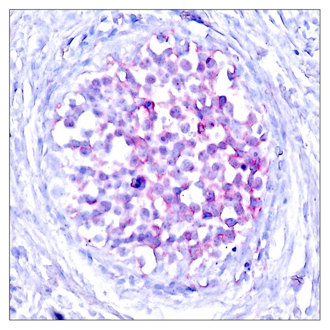 RAF1 / RAF Antibody - Immunohistochemistry analysis of paraffin-embedded human breast carcinoma, using C-RAF (Phospho-Ser259) Antibody.