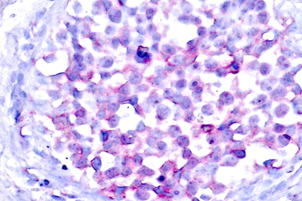 RAF1 / RAF Antibody - IHC of p-Raf1 (S259) pAb in paraffin-embedded human breast carcinoma tissue.