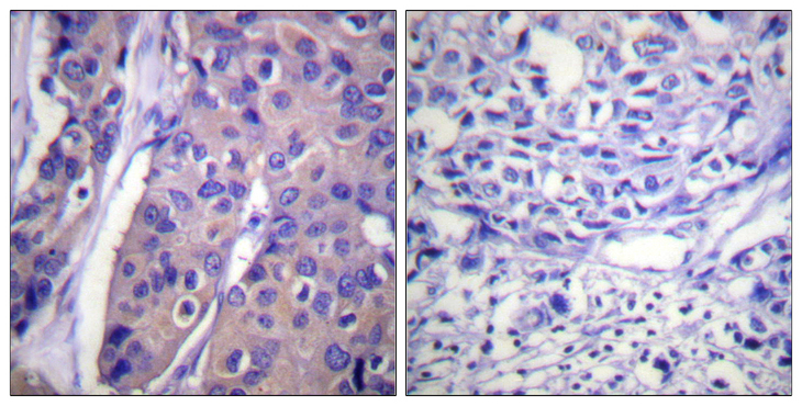 RAF1 / RAF Antibody - Immunohistochemistry analysis of paraffin-embedded human breast carcinoma, using C-RAF (Phospho-Ser296) Antibody. The picture on the right is blocked with the phospho peptide.