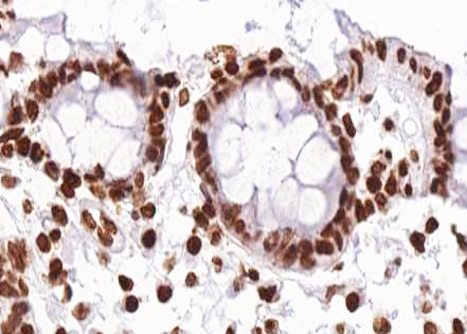 RAF1 / RAF Antibody - 1:100 staining human colon carcinoma tissue by IHC-P. The tissue was formaldehyde fixed and a heat mediated antigen retrieval step in citrate buffer was performed. The tissue was then blocked and incubated with the antibody for 1.5 hours at 22°C. An HRP conjugated goat anti-rabbit antibody was used as the secondary.