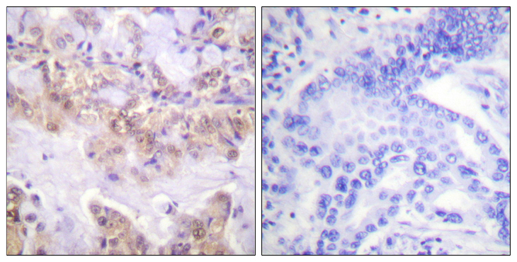 RAF1 / RAF Antibody - Immunohistochemistry analysis of paraffin-embedded human lung carcinoma, using C-RAF (Phospho-Ser621) Antibody. The picture on the right is blocked with the phospho peptide.