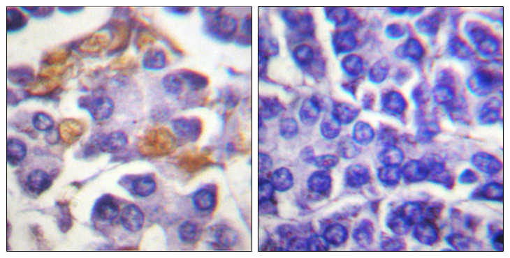 RAF1 / RAF Antibody - Immunohistochemistry analysis of paraffin-embedded human pancreas, using C-RAF (Phospho-Tyr341) Antibody. The picture on the right is blocked with the phospho peptide.
