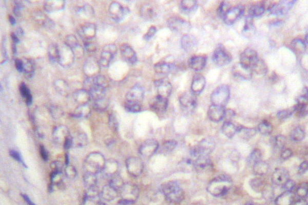 RAF1 / RAF Antibody - IHC of C-Raf (S291) pAb in paraffin-embedded human breast carcinoma tissue.