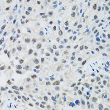 RAG2 / RAG-2 Antibody - Immunohistochemistry of paraffin-embedded human lung cancer tissue.