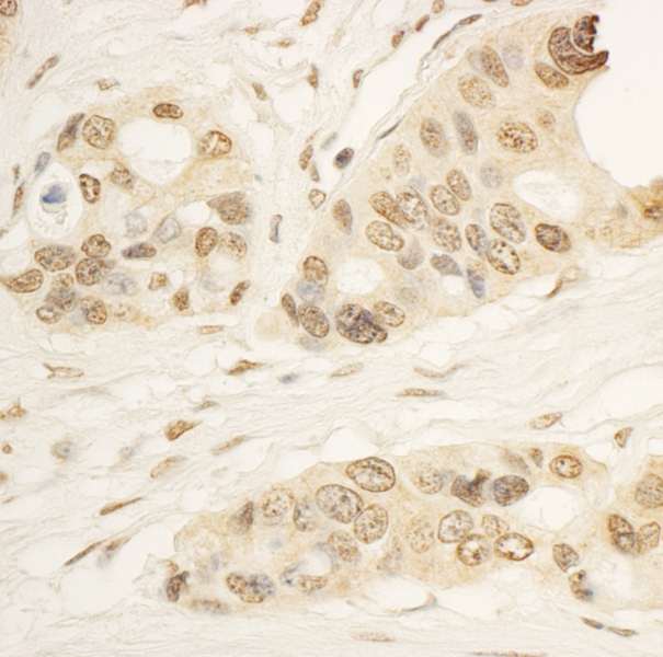 RAI1 Antibody - Detection of Human RAI1 by Immunohistochemistry. Sample: FFPE section of human ovarian carcinoma. Antibody: Affinity purified rabbit anti-RAI1 used at a dilution of 1:1000 (1 ug/ml). Detection: DAB.