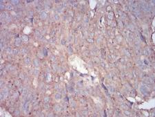 RALA / RAL Antibody - Immunohistochemical analysis of paraffin-embedded ovarian cancer tissues using RALA mouse mAb with DAB staining.