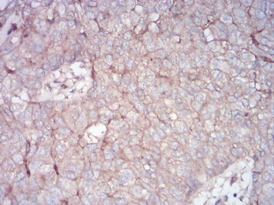 RALA / RAL Antibody - Immunohistochemical analysis of paraffin-embedded bladder cancer tissues using RALA mouse mAb with DAB staining.