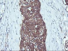 RALB Antibody - IHC of paraffin-embedded Carcinoma of Human lung tissue using anti-RALB mouse monoclonal antibody.