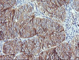 RALB Antibody - IHC of paraffin-embedded Adenocarcinoma of Human ovary tissue using anti-RALB mouse monoclonal antibody.