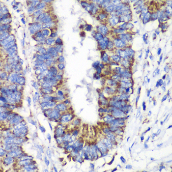 RALB Antibody - Immunohistochemistry of paraffin-embedded human colon carcinoma tissue.