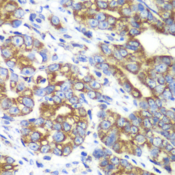 RALB Antibody - Immunohistochemistry of paraffin-embedded human gastric cancer tissue.