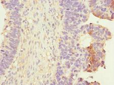 RALB Antibody - Immunohistochemistry of paraffin-embedded human ovarian cancer at dilution 1:100