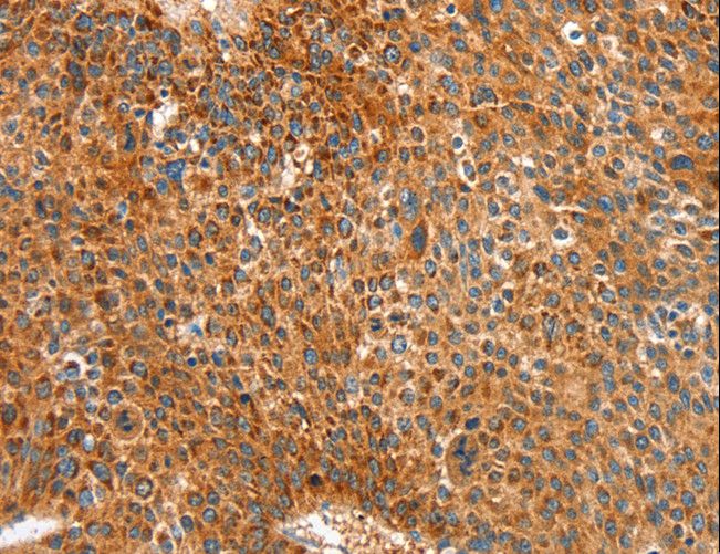 RALDH2 / ALDH1A2 Antibody - Immunohistochemistry of paraffin-embedded Human colon cancer using ALDH1A2 Polyclonal Antibody at dilution of 1:30.
