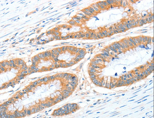 RALDH2 / ALDH1A2 Antibody - Immunohistochemistry of paraffin-embedded Human colon cancer using ALDH1A2 Polyclonal Antibody at dilution of 1:30.