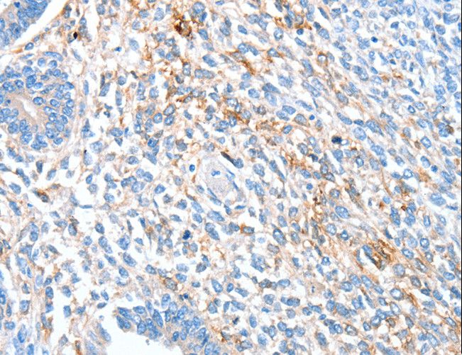 RALDH2 / ALDH1A2 Antibody - Immunohistochemistry of paraffin-embedded Human ovarian cancer using ALDH1A2 Polyclonal Antibody at dilution of 1:60.