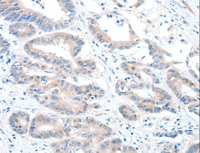RALDH2 / ALDH1A2 Antibody - Immunohistochemistry of paraffin-embedded Human colon cancer using ALDH1A2 Polyclonal Antibody at dilution of 1:60.