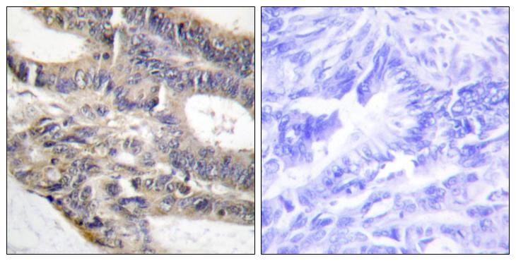RALGAPA2 Antibody - Peptide - + Immunohistochemistry analysis of paraffin-embedded human colon carcinoma tissue using AS250 antibody.