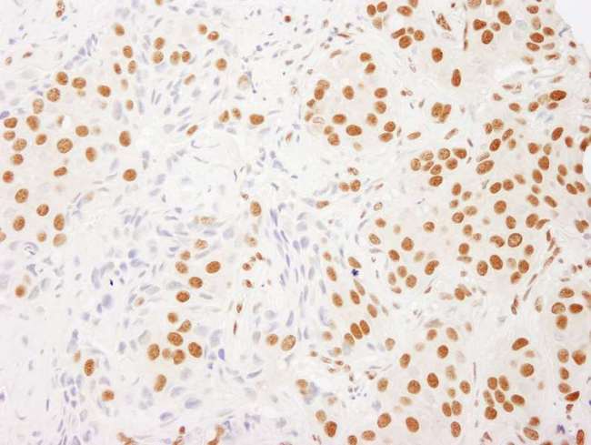 RALY Antibody - Detection of Human RALY by Immunohistochemistry. Sample: FFPE section of human breast carcinoma. Antibody: Affinity purified rabbit anti-RALY used at a dilution of 1:1000 (1 ug/ml). Detection: DAB.