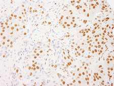 RALY Antibody - Detection of Human RALY by Immunohistochemistry. Sample: FFPE section of human breast carcinoma. Antibody: Affinity purified rabbit anti-RALY used at a dilution of 1:1000 (1 ug/ml). Detection: DAB.