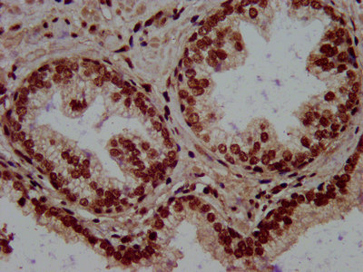 RALY Antibody - Immunohistochemistry image at a dilution of 1:500 and staining in paraffin-embedded human prostate cancer performed on a Leica BondTM system. After dewaxing and hydration, antigen retrieval was mediated by high pressure in a citrate buffer (pH 6.0) . Section was blocked with 10% normal goat serum 30min at RT. Then primary antibody (1% BSA) was incubated at 4 °C overnight. The primary is detected by a biotinylated secondary antibody and visualized using an HRP conjugated SP system.