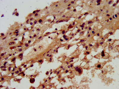 RAMA1 / SKA3 Antibody - Immunohistochemistry image at a dilution of 1:300 and staining in paraffin-embedded human melanoma cancer performed on a Leica BondTM system. After dewaxing and hydration, antigen retrieval was mediated by high pressure in a citrate buffer (pH 6.0) . Section was blocked with 10% normal goat serum 30min at RT. Then primary antibody (1% BSA) was incubated at 4 °C overnight. The primary is detected by a biotinylated secondary antibody and visualized using an HRP conjugated SP system.